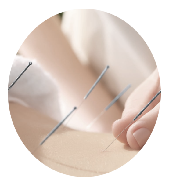 Photo d'une séance d'acupuncture du dos