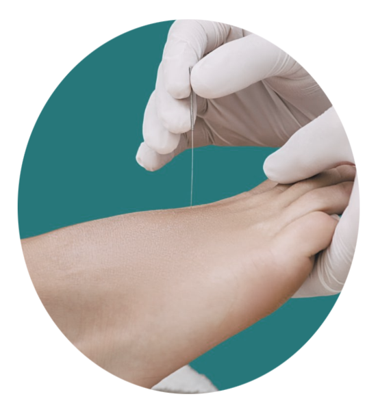 Photo d'une séance d'acupuncture oculaire