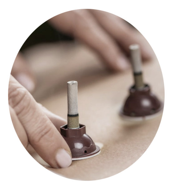 Photo d'une séance de moxibustion du dos